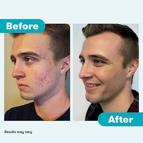 Proactiv 3 Step Acne Treatment - Benzoyl Peroxide Face Wash, Repairing Acne Spot Treatment for Face And Body, Exfoliating Toner - 60 Day Complete Acne Skin Care Kit, Multicolor