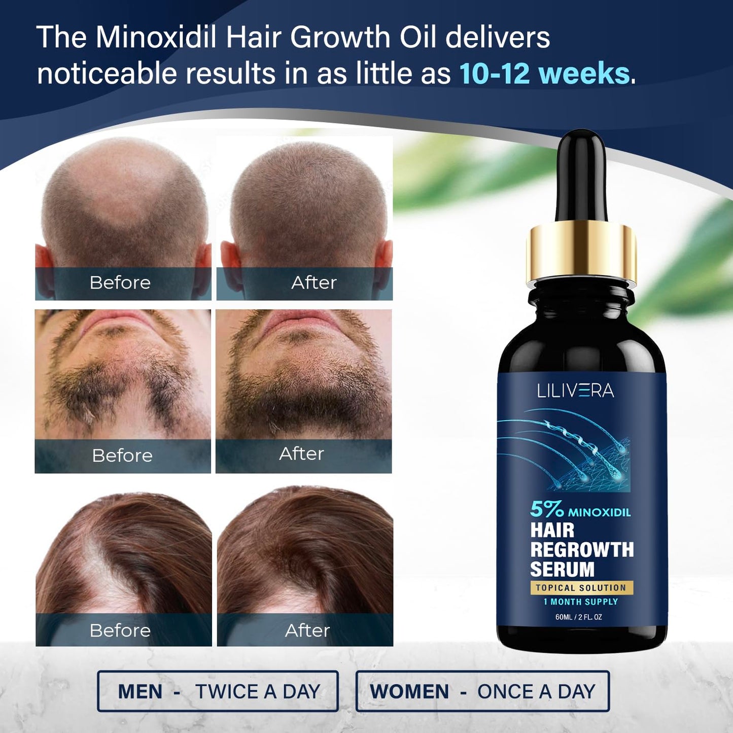 5% Minoxidil for Men and Women Kit, Hair Growth Serum, Minoxidil 5 Percent for Hair Loss, Hair Regrowth Treatment for Thicker Fuller Hair, Minoxidil for Hair Growth, Hair Loss Treatments, 60ML