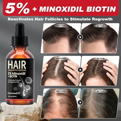 Hair Growth Serum, 5% Minoxidil & Biotin for Hair Growth for Women & Men, Hair Loss Treatments, Hair Regrowth Treatment for Thicker Longer Fuller Hair, 2 Fl Oz 1