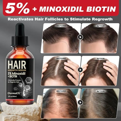 Hair Growth Serum, 5% Minoxidil & Biotin for Hair Growth for Women & Men, Hair Loss Treatments, Hair Regrowth Treatment for Thicker Longer Fuller Hair, 2 Fl Oz 1