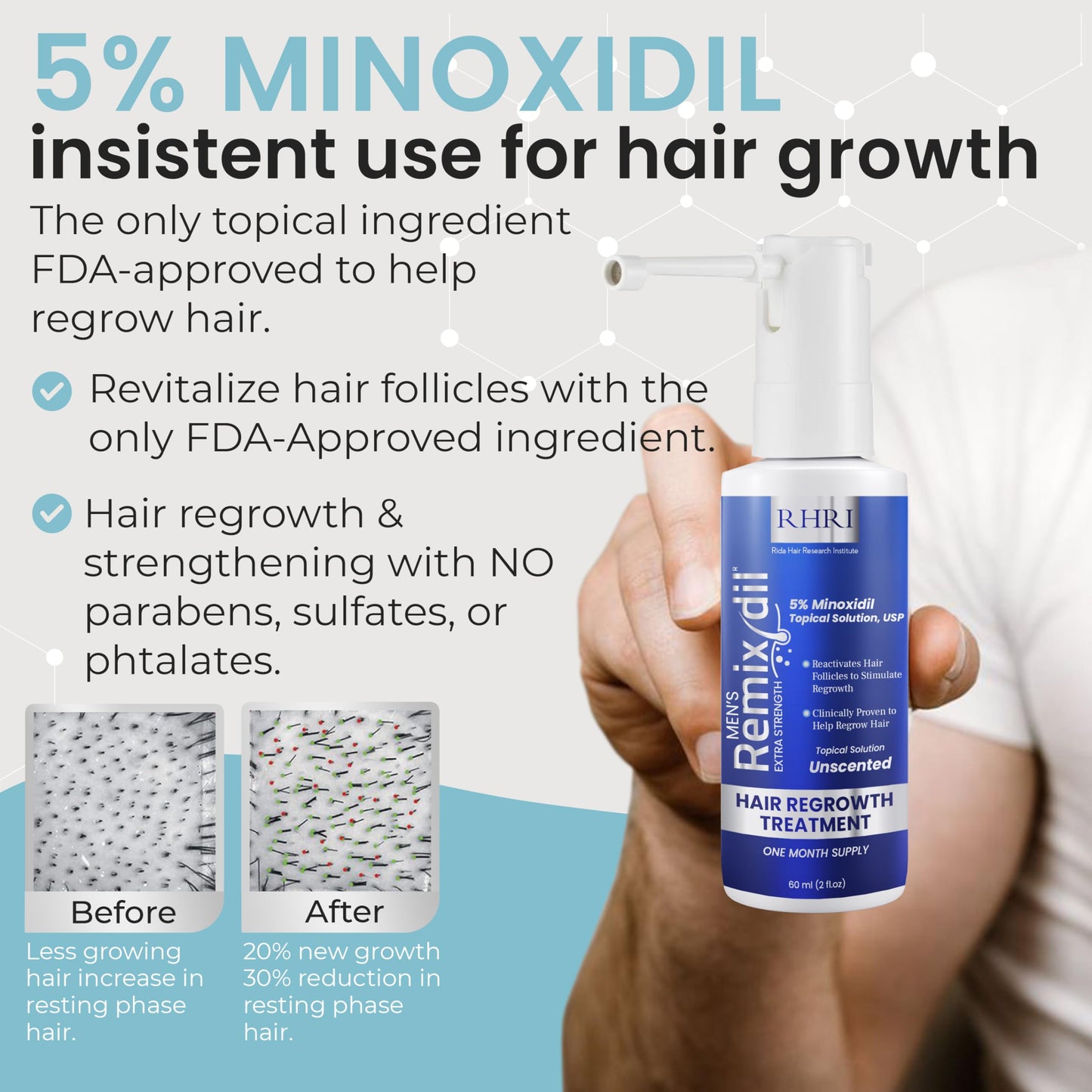 Remixidil Men’s 5% Minoxidil Spray | Hair Regrowth Treatment for Men|Clinically Proven Formula for Hair Loss and Hair Growth | Unscented Topical Spray Treatment for Thinning Hair |1 to 2 Month Supply