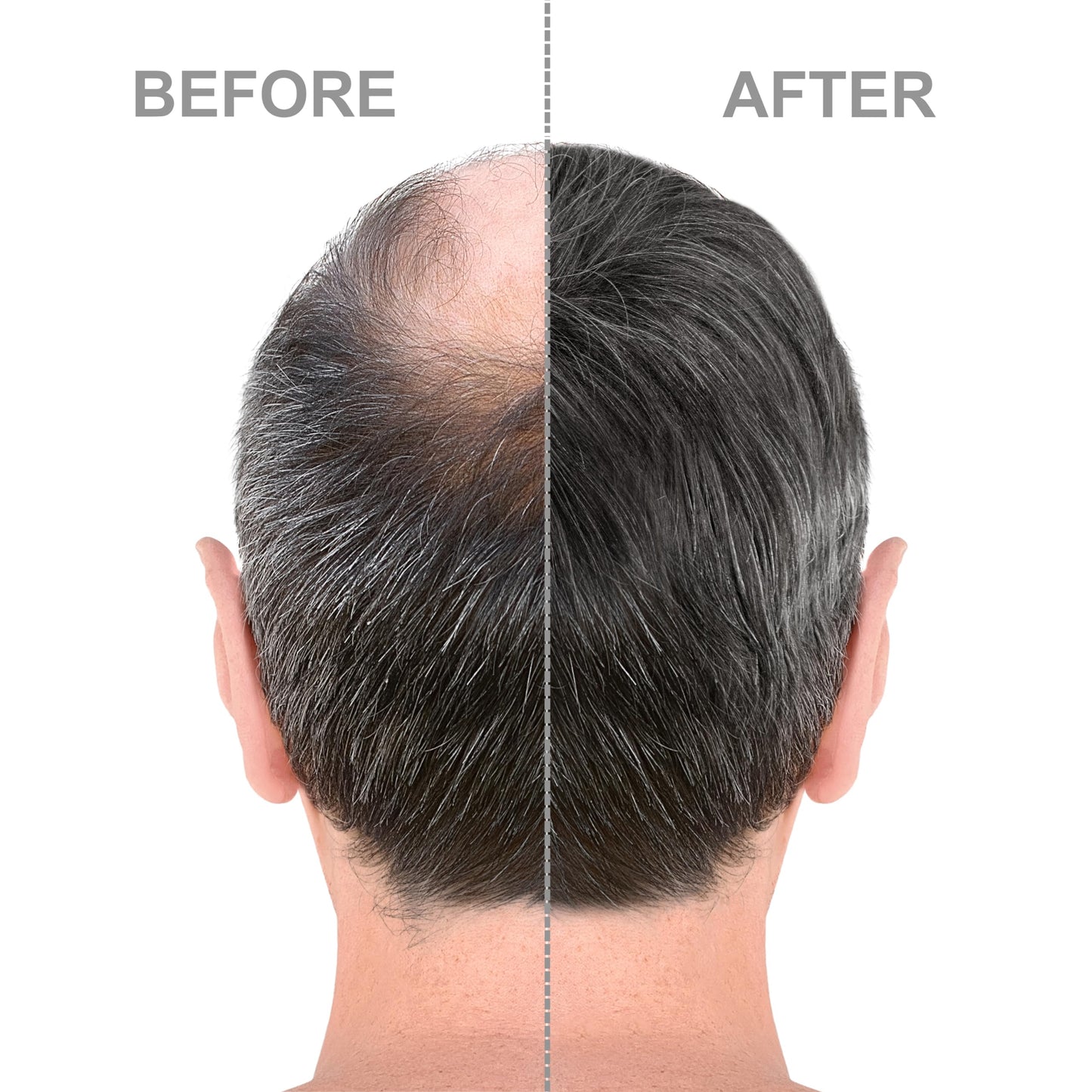 Hair-Regen Advanced 5% Minoxidil Hair Regrowth Treatment for Men- 6 Month Supply, Hair Loss Treatment, Minoxidil Topical Solution for Thicker, Fuller Hair