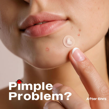 AVARELLE Pimple Patches |Hydrocolloid Acne Patches |ZITOUT FSA HSA Eligible Pimple Patches for Face with Tea Tree, Cica, & Calendula |Vegan, Cruelty Free, Carbonfree