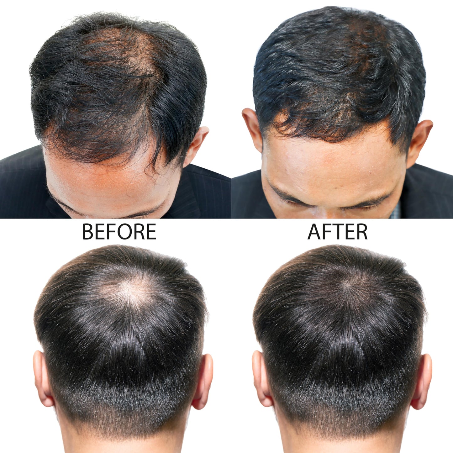 Hair-Regen Advanced 5% Minoxidil Hair Regrowth Treatment for Men- 6 Month Supply, Hair Loss Treatment, Minoxidil Topical Solution for Thicker, Fuller Hair